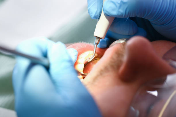 Best Emergency Root Canal Treatment in Somerset, KY